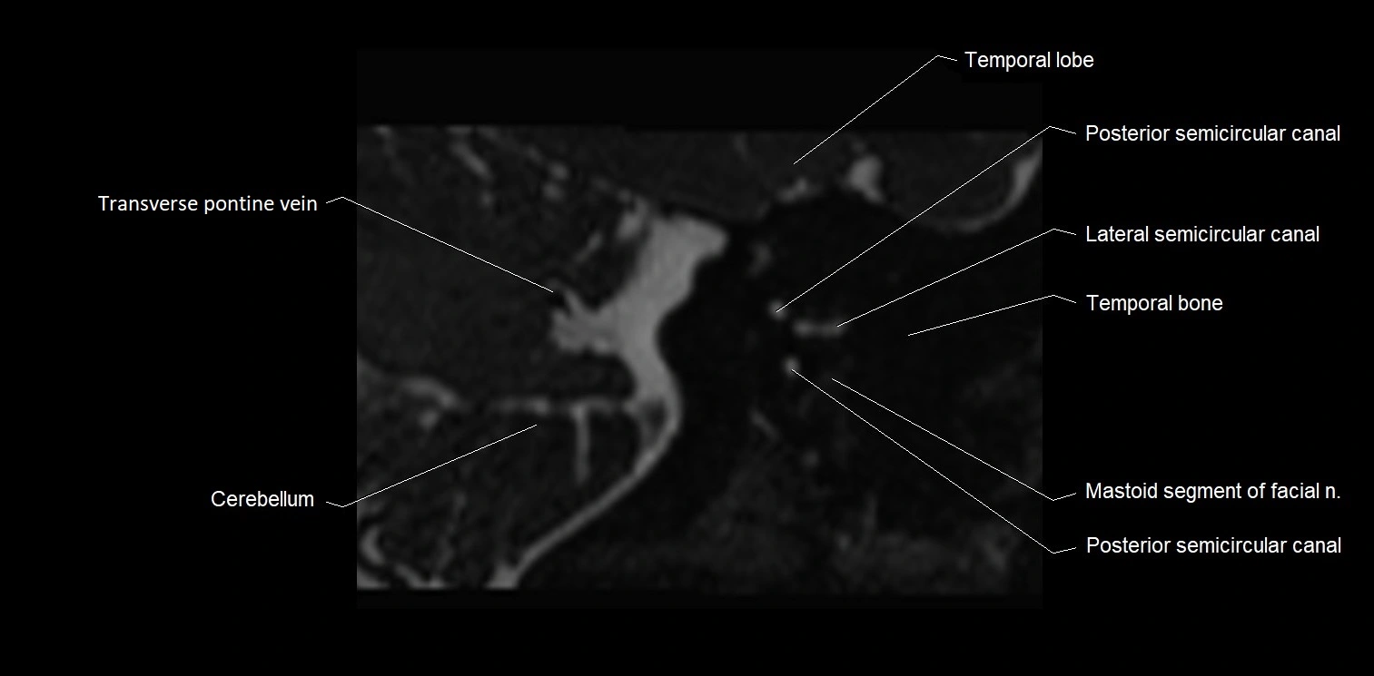 Internal auditory meatus (IAM) axial cross sectional anatomy image 28.webp